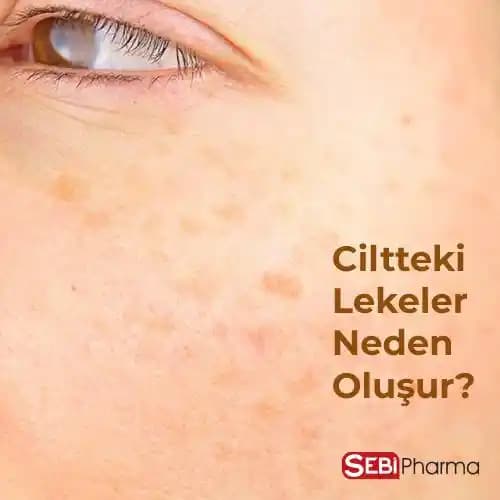 Ciltte Siyah Lekelerin Nedenleri, Önlenmesi ve Etkili Tedavi Yöntemleri