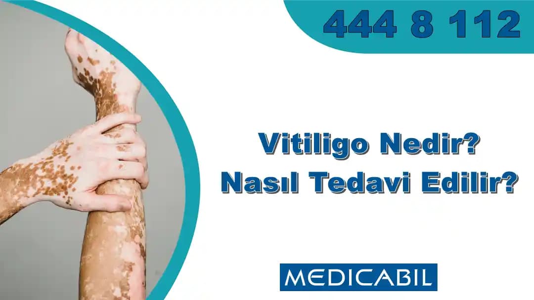 Deride Beyaz Leke Nedenleri, Önlenmesi ve Etkili Tedavi Yöntemleri Hakkında Bilgi