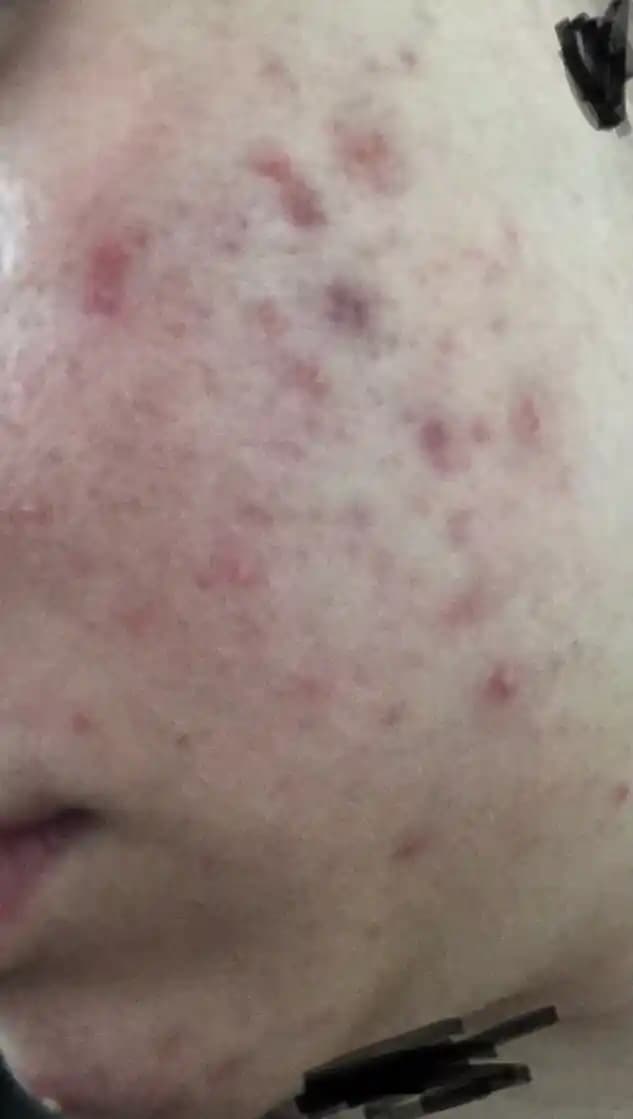 Derinin Altında Sivilce Nedenleri, Belirtileri ve Etkili Tedavi Yöntemleri