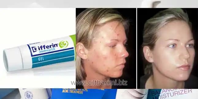 Differin Jel Nedir ve Akne Tedavisinde Etkili Cilt Bakım Çözümü