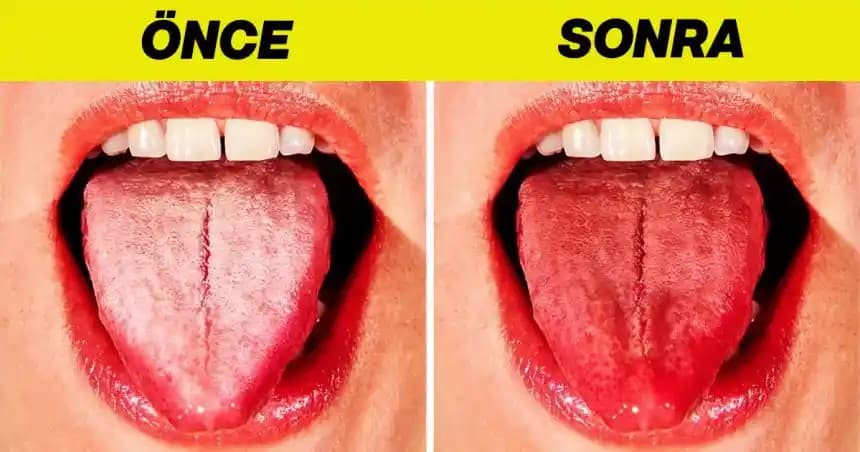 Dil Beyazlamasının Nedenleri, Önemi ve Etkili Temizlik Yöntemleri Hakkında Bilgi