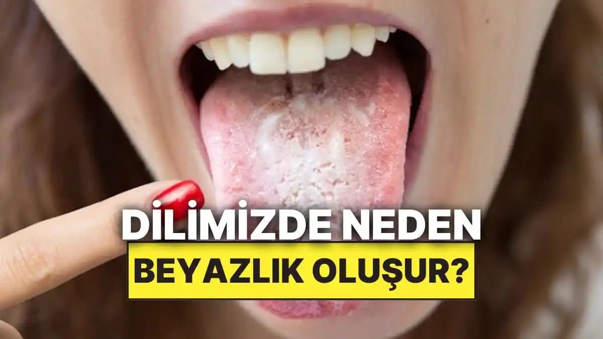 Dil Beyazlaşmasının Nedenleri, Önlemleri ve Kişisel Bakımda Etkili Yöntemler