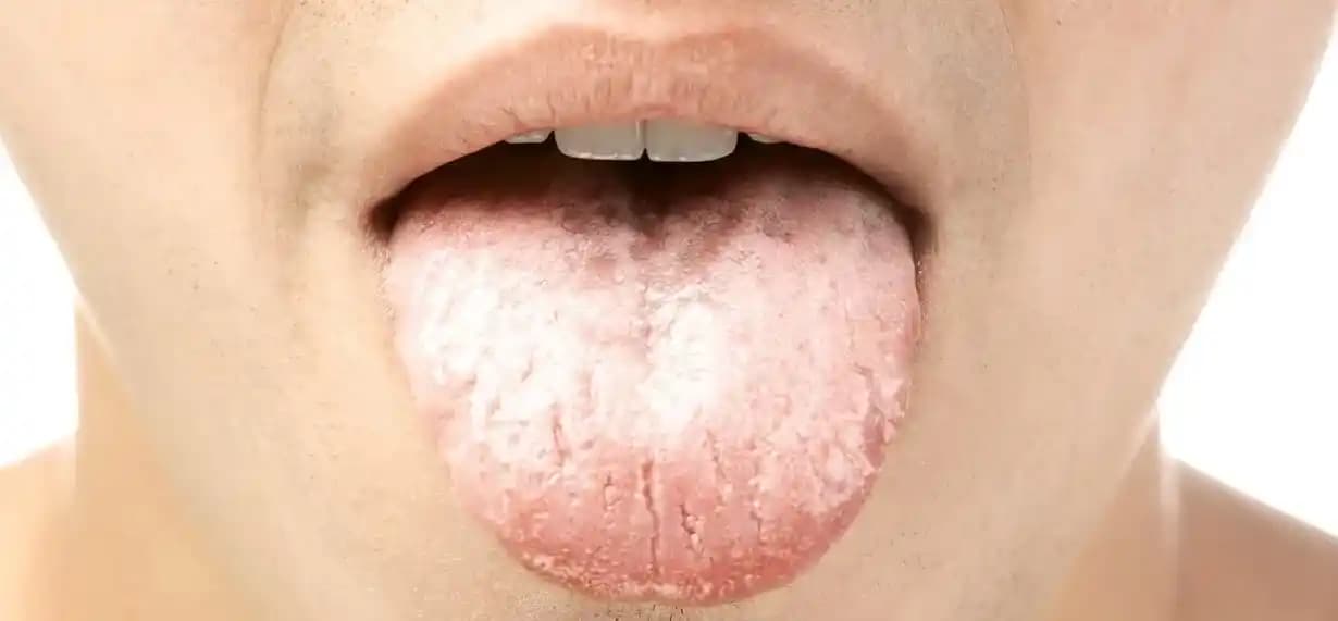 Dil Beyazlığı: Nedenleri, Belirtileri ve Etkili Tedavi Yöntemleri Hakkında Rehber