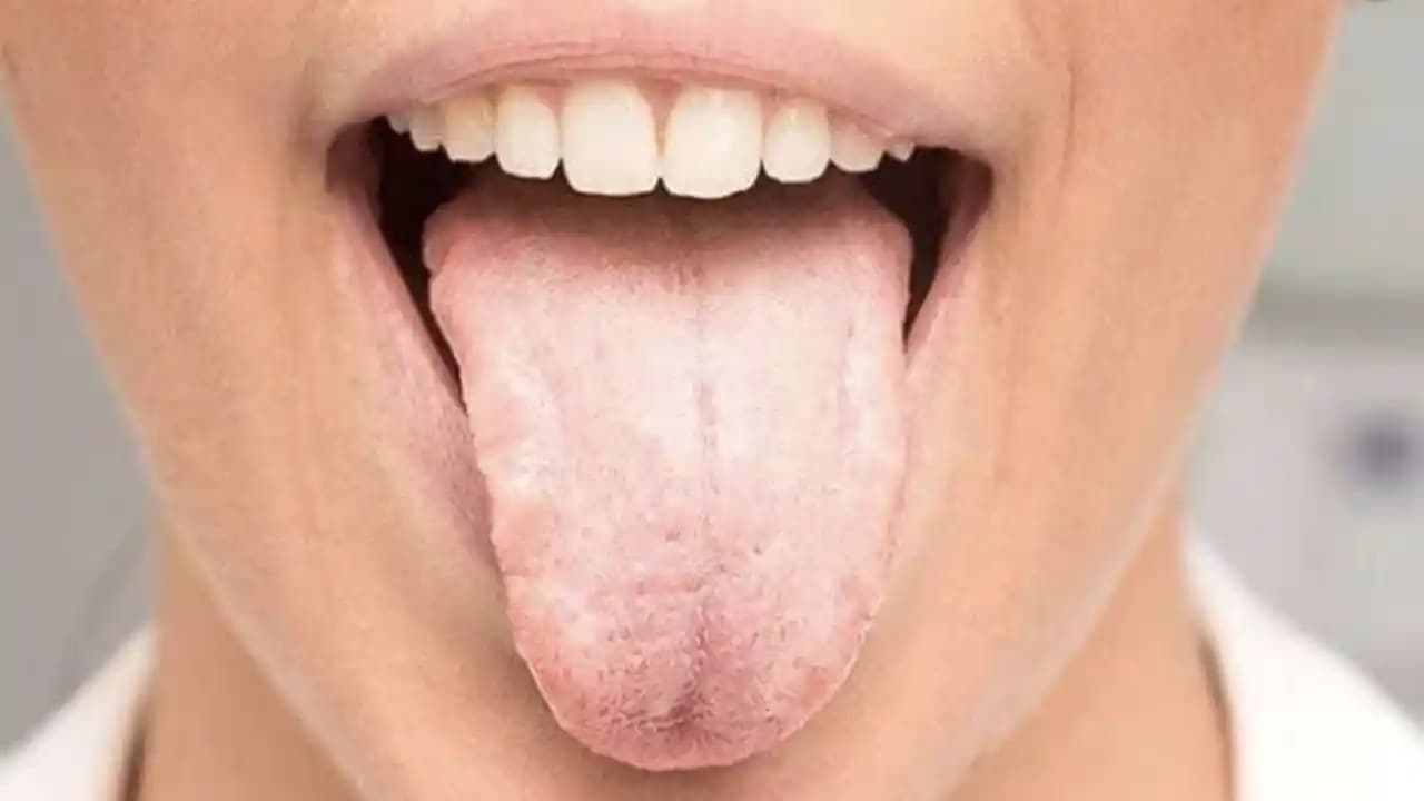 Dilde Beyazlık Nedenleri, Belirtileri ve Etkili Tedavi Yöntemleri Rehberi