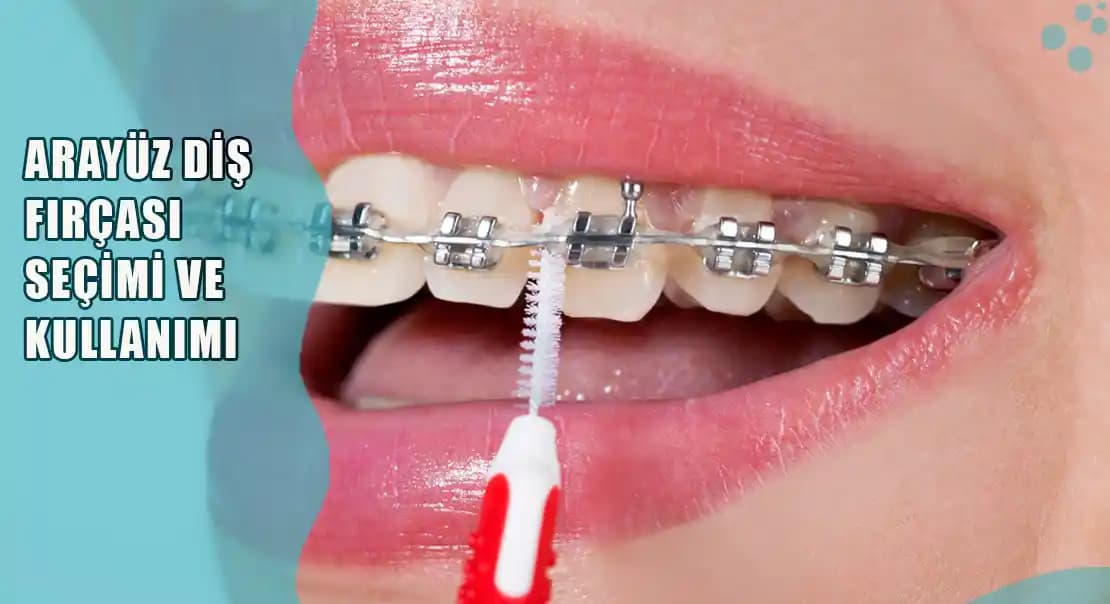 Diş Arası Fırçası Kullanımı ve Ağız Sağlığı İçin Doğru Teknikler