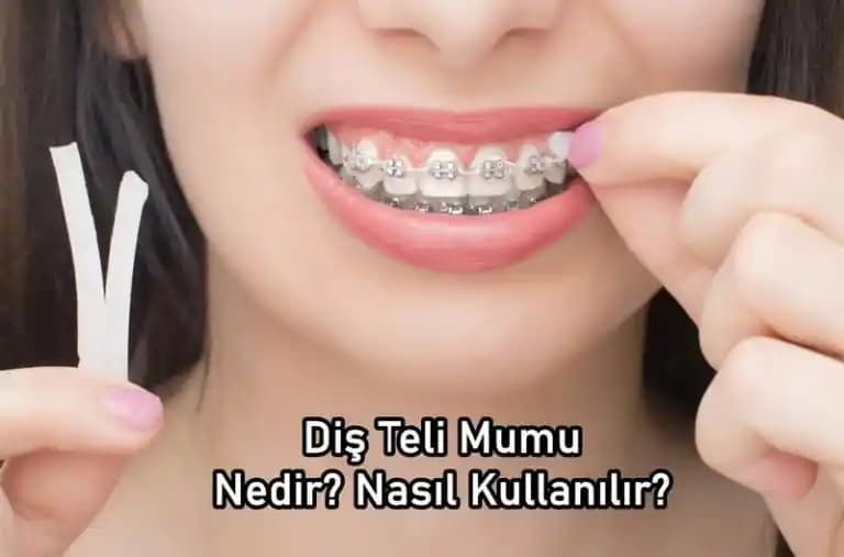 Diş Teli Mumu Nedir? Ortodontik Tedavide Rahatlık ve Tahriş Önleyici Çözüm
