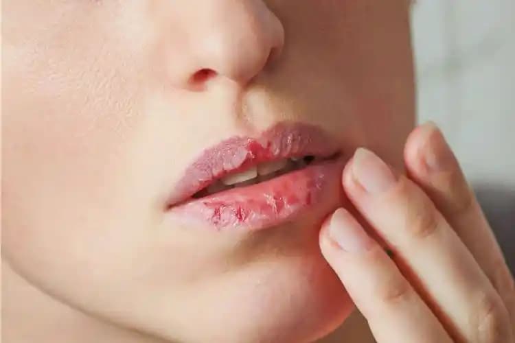 Dudak İltihabına Ne İyi Gelir? Etkili Çözümler ve Bakım Önerileri