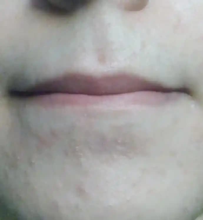 Dudak Kenarında Kızarıklık Nedenleri, Tedavi Yöntemleri ve Önleyici Öneriler