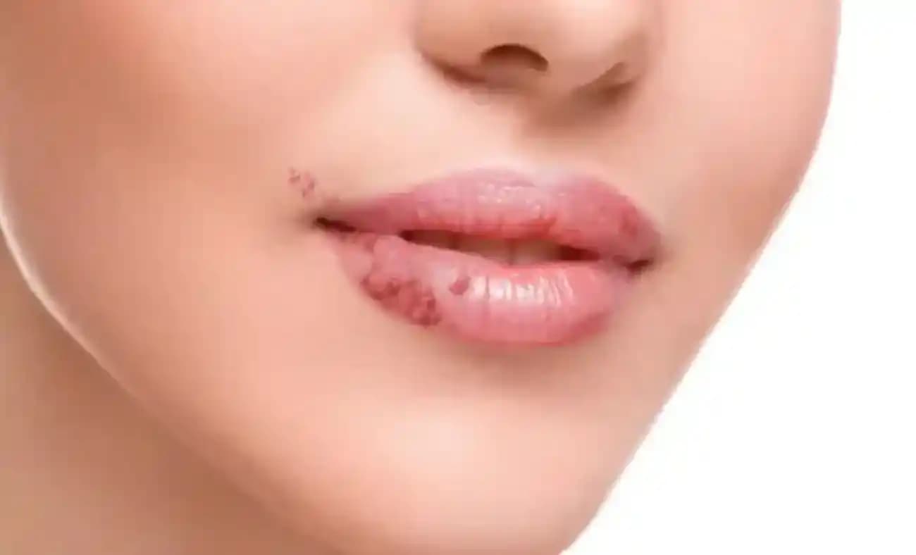 Dudak Mantarı Nasıl Geçer? Etkili Tedavi ve Doğal Çözümlerle Mantar Enfeksiyonu