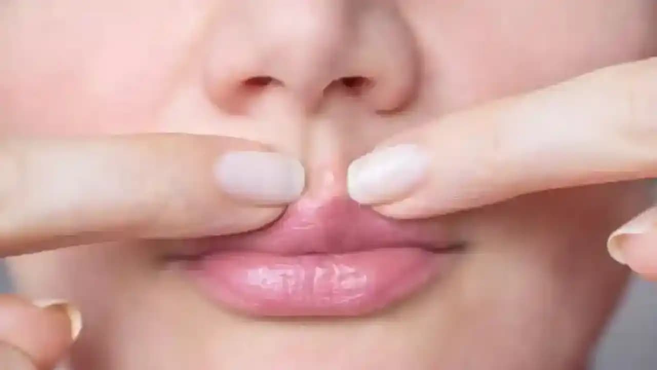 Dudak Üstünde Sivilce Nedenleri ve Etkili Tedavi Yöntemleri Rehberi