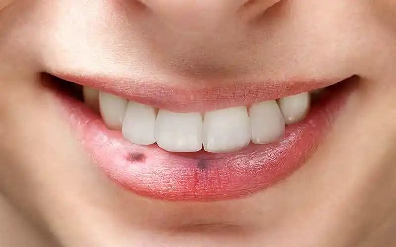 Dudakta Siyah Nokta Nedenleri, Önleme Yöntemleri ve Etkili Tedavi Seçenekleri