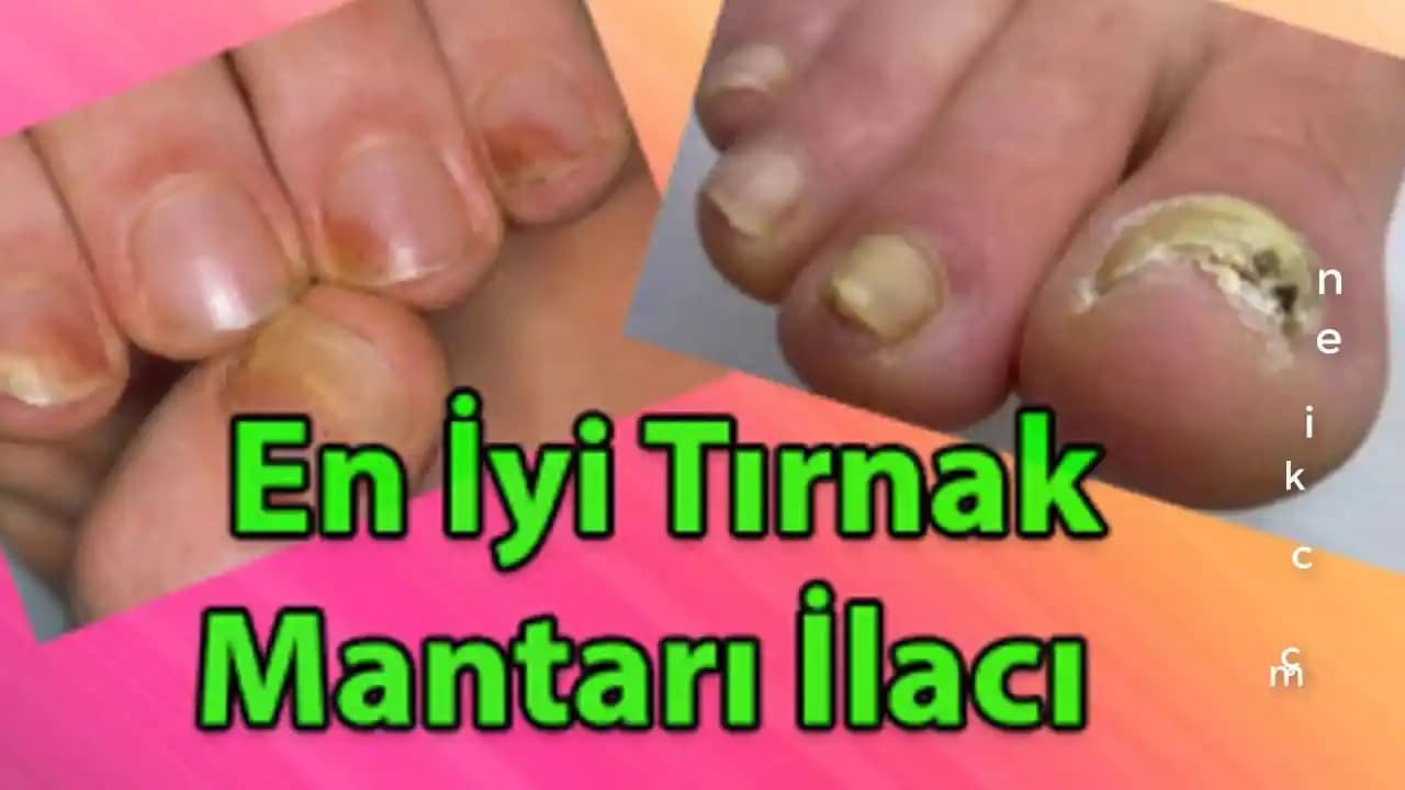 Eczaneden Tırnak Mantarı İlacı: Etkili Tedavi ve Bakım Yöntemleri Rehberi