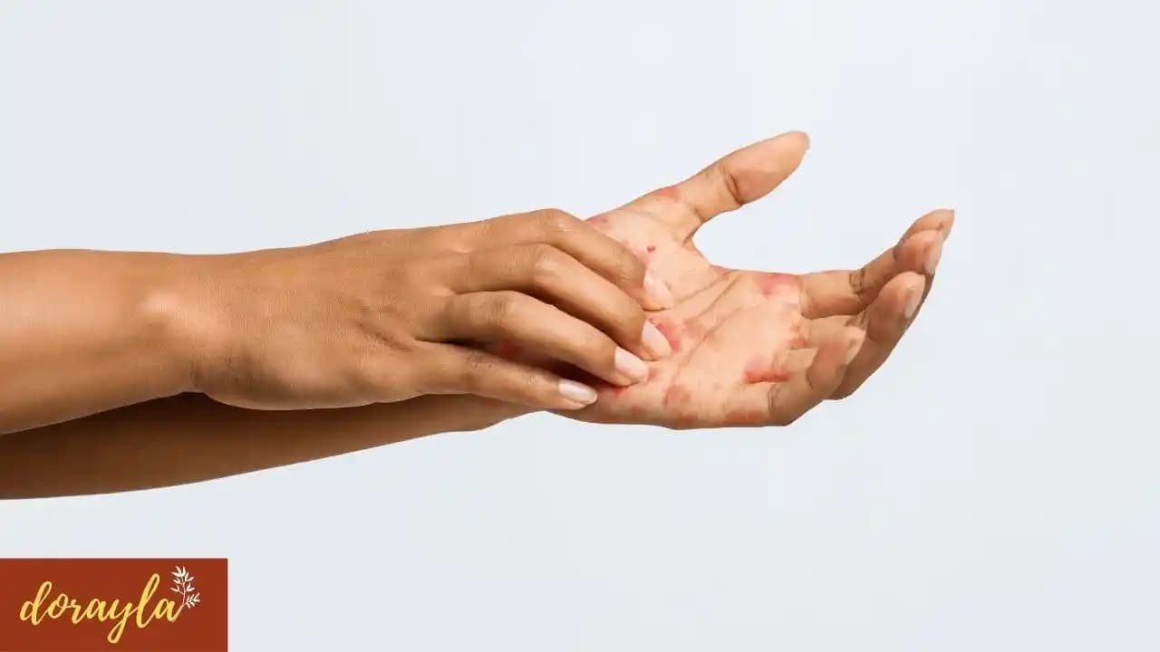 Egzama Tedavisinde Pudra Kullanımı: Doğru Seçim ve Etkileri Hakkında Bilgi