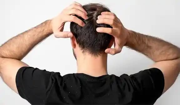 Erkeklerde Kepek Sorunu: Nedenleri, Önleme Yolları ve Etkili Tedavi Seçenekleri