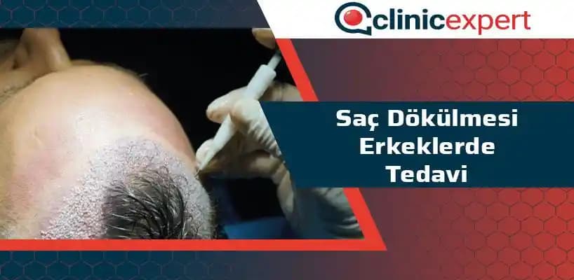 Erkeklerde Kıl Dökülmesi: Nedenleri, Tedavi Yöntemleri ve Etkili Bakım Önerileri