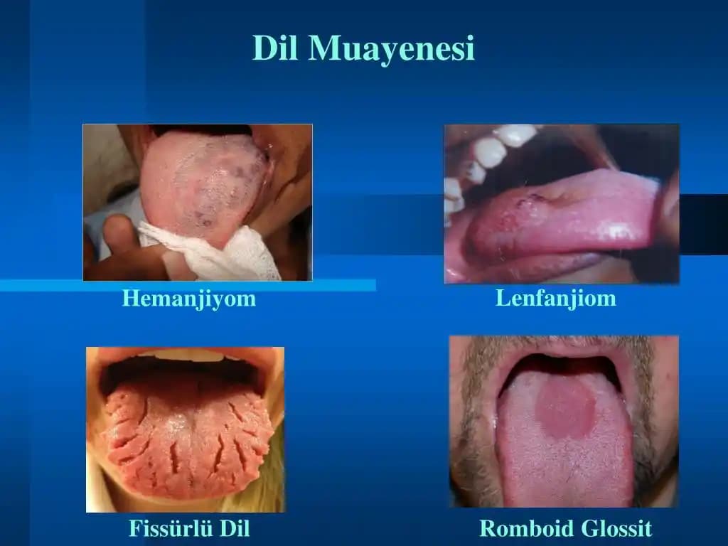 Fissürlü Dil Tedavisi: Ağız Sağlığı ve Estetik İçin Kapsamlı Rehber