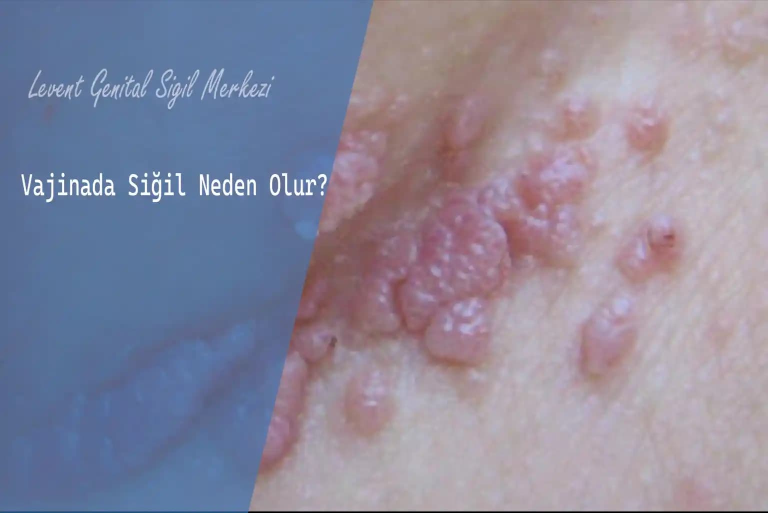 Genital Bölge Pişiği: Nedenleri, Belirtileri ve Etkili Korunma ve Tedavi Yöntemleri