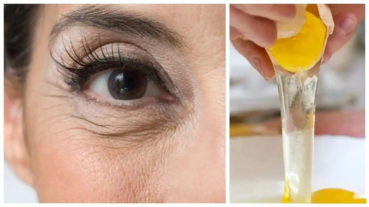 Göz Altı Kırışıkları: Nedenleri, Önleme Yöntemleri ve Etkili Tedavi Seçenekleri