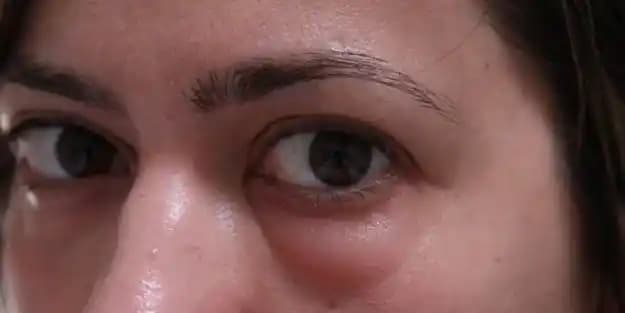 Göz Altı Şişmesi Nasıl Geçer? Etkili Doğal Yöntemler ve Bakım Önerileri