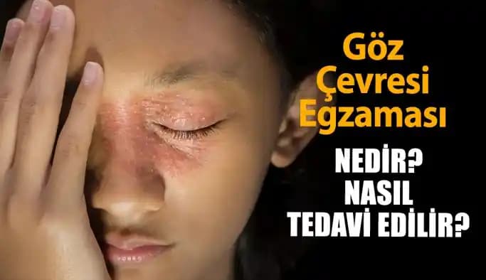 Göz Egzaması Nedir? Belirtileri, Nedenleri ve Etkili Tedavi Yöntemleri
