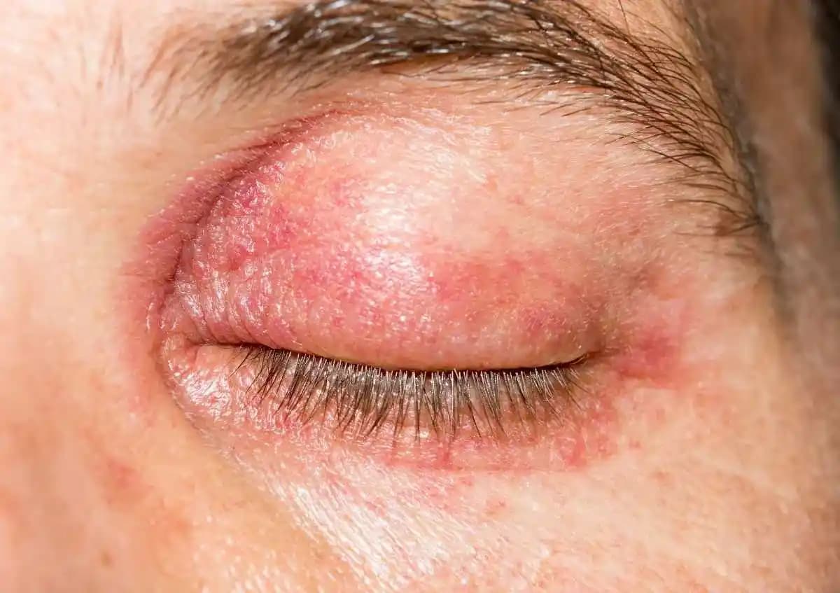 Göz Kapağı Üstünde Egzama: Nedenleri, Belirtileri ve Etkili Tedavi Yöntemleri