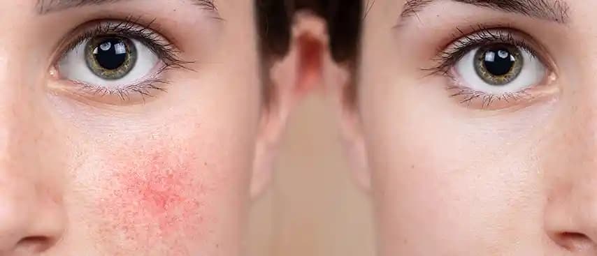 Gül Hastalığının Tedavisinde Etkili Yöntemler ve Yaşam Tarzı Önerileri