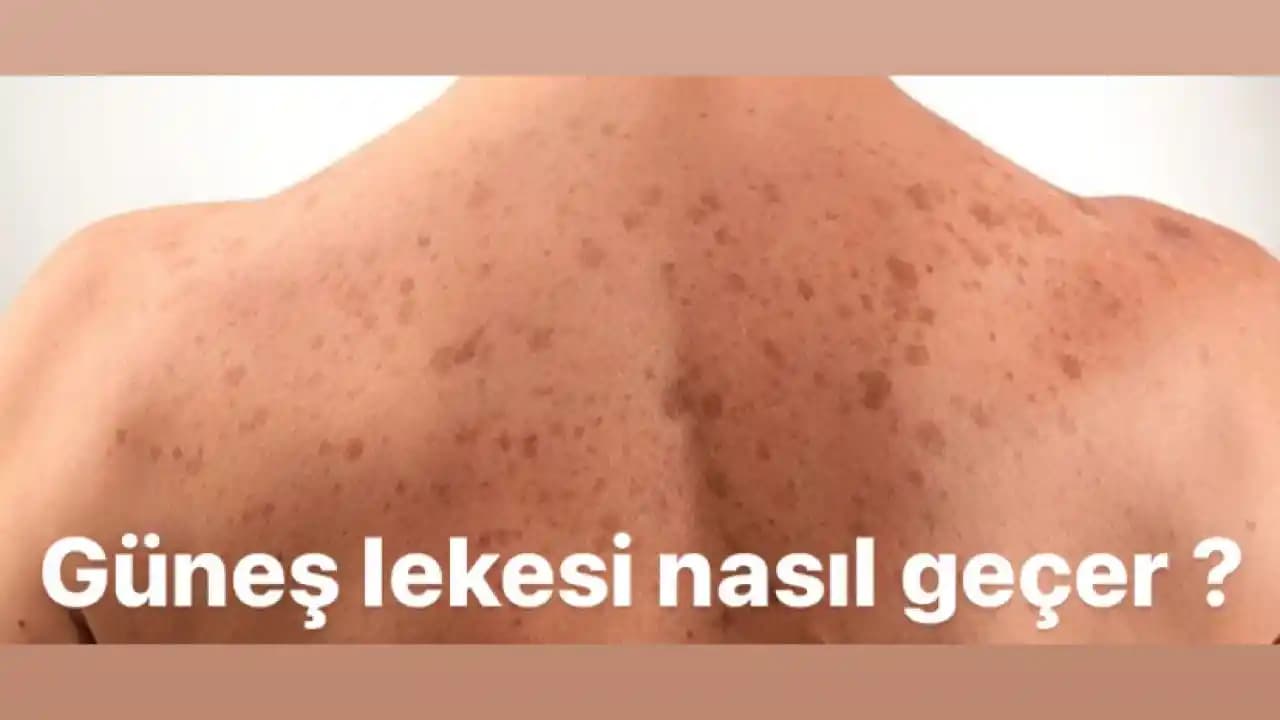 Güneş Lekesi Nasıl Geçer? Etkili Yöntemler ve Korunma Yolları Hakkında Bilgi