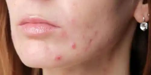 Hamilelikte Sivilce Nedenleri, Tedavi Yöntemleri ve Etkili Cilt Bakımı Önerileri