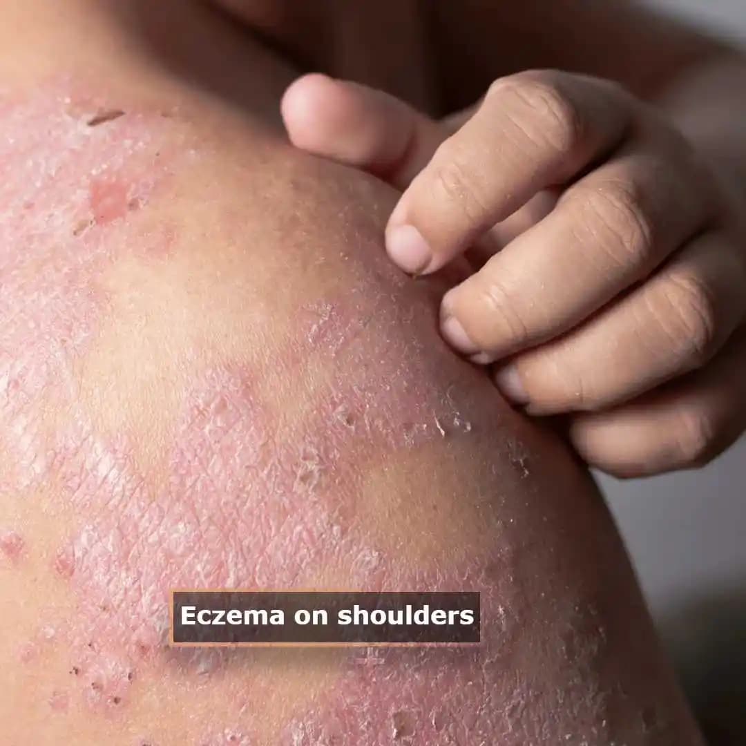Head and Shoulders Egzama: Saç Derisi Sağlığını Korumada Etkili Yaklaşımlar