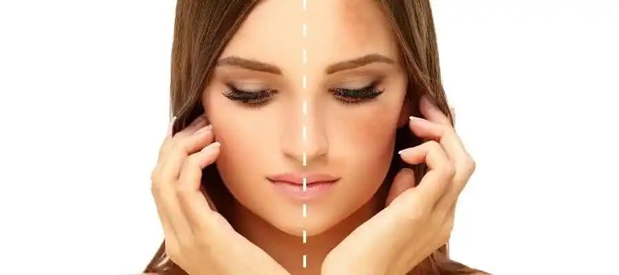 Hiperpigmentasyon Nedir? Ciltte Renk Değişimlerinin Nedenleri ve Tedavi Yöntemleri