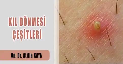 Kıl Dönmesi ile Sivilce Arasındaki Farklar ve Etkili Cilt Bakımı Rehberi