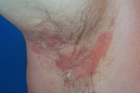 Koltuk Altı Kaşıntısı Tedavisi: Nedenleri, Belirtileri ve Etkili Bakım Yöntemleri