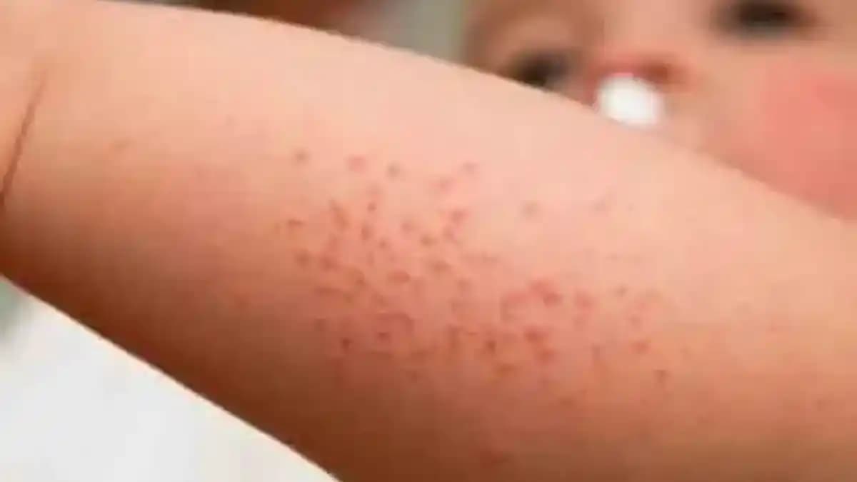 Koltuk Altı Pişik Nedenleri ve Doğal Tedavi Yöntemleriyle Etkili Çözümler