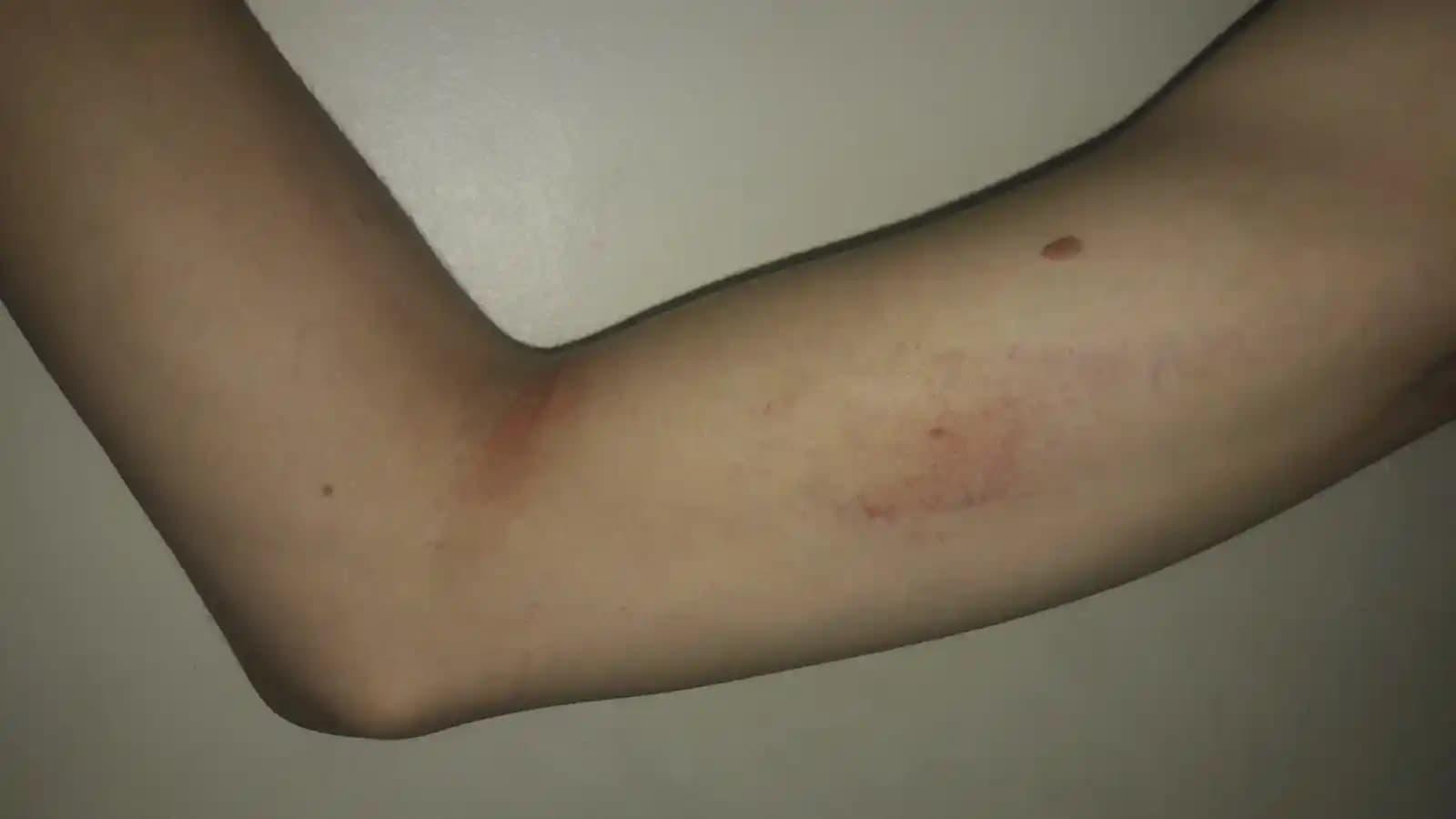 Koltuk Altında Morarma Nedenleri ve Önleme Yöntemleri: Kapsamlı Rehber