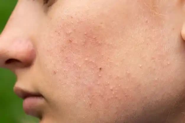 Komedon Nedir? Etkili Çözümler ve Cilt Bakım Önerileri ile Gözenek Tıkanıklığını Önleme