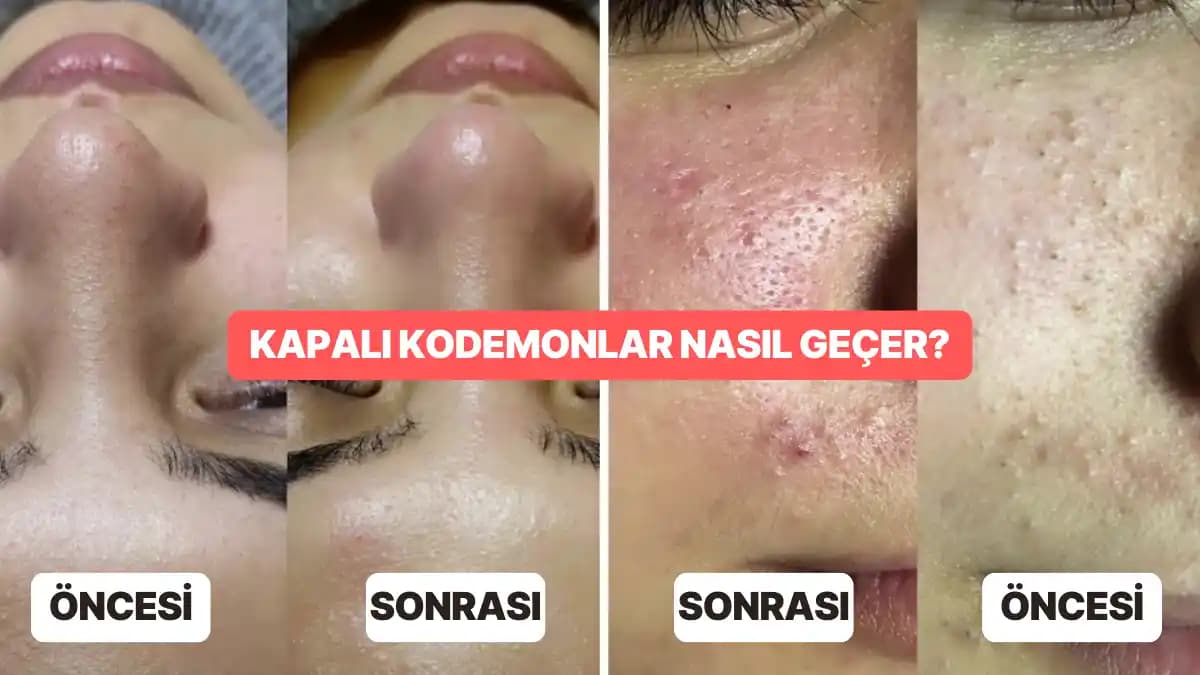 Komedon Nedir ve Nasıl Geçer? Etkili Cilt Bakımı ve Tedavi Yöntemleri