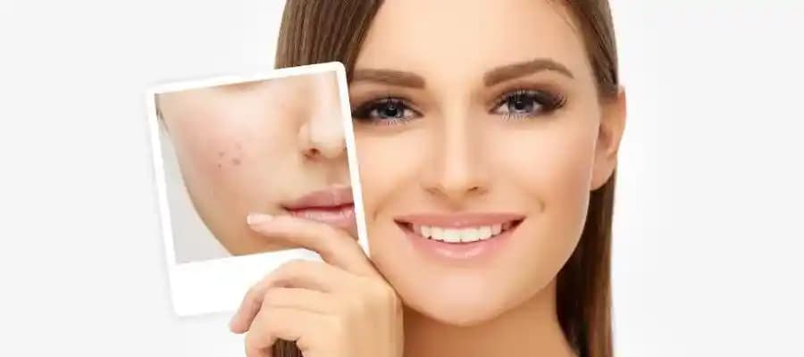 Kör Sivilce Nedir? Belirtileri, Nedenleri ve Etkili Tedavi Yöntemleri