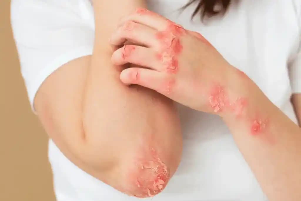 Kuru Cilt Egzaması Nedenleri, Belirtileri ve Etkili Tedavi Yöntemleri Hakkında Bilgi