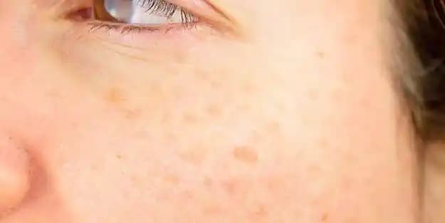 Laktik Asidin Cilt Bakımındaki Faydaları ve Güzellik Rutininize Etkileri