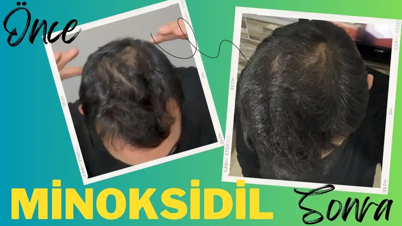 Minoxidil'in Saç Çıkarma Etkisi ve Kullanım Rehberi: Saç Dökülmesini Önleme Yöntemleri