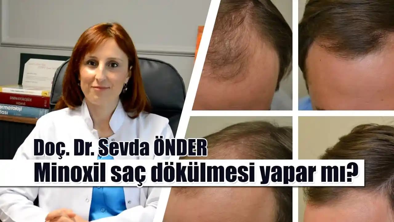 Minoxil Saç Dökülmesini Önler mi? Doğru Kullanım ve Yan Etkiler Hakkında Bilgi