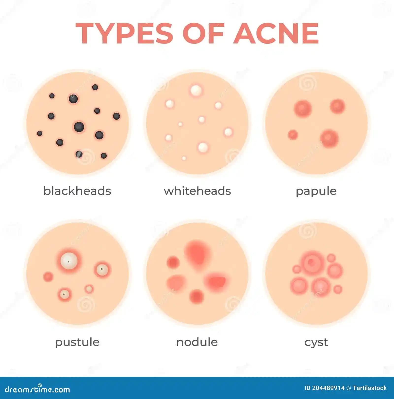 Nodül Sivilce Nedir? Nedenleri, Belirtileri ve Etkili Tedavi Yöntemleri
