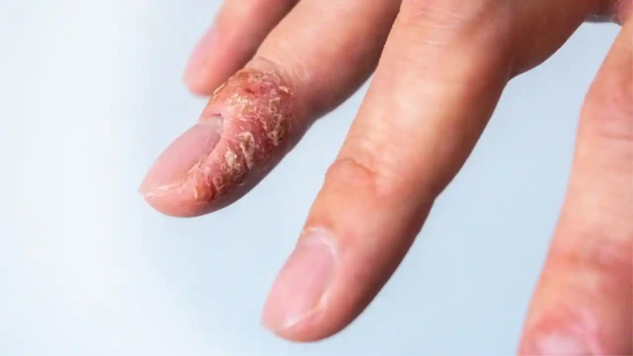 Parmak Arası Egzama: Nedenleri, Belirtileri ve Etkili Tedavi Yöntemleri Hakkında Bilgi