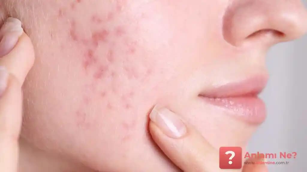 Popoda Sivilce Nedenleri, Önleme Yolları ve Evde Doğal Tedavi Yöntemleri