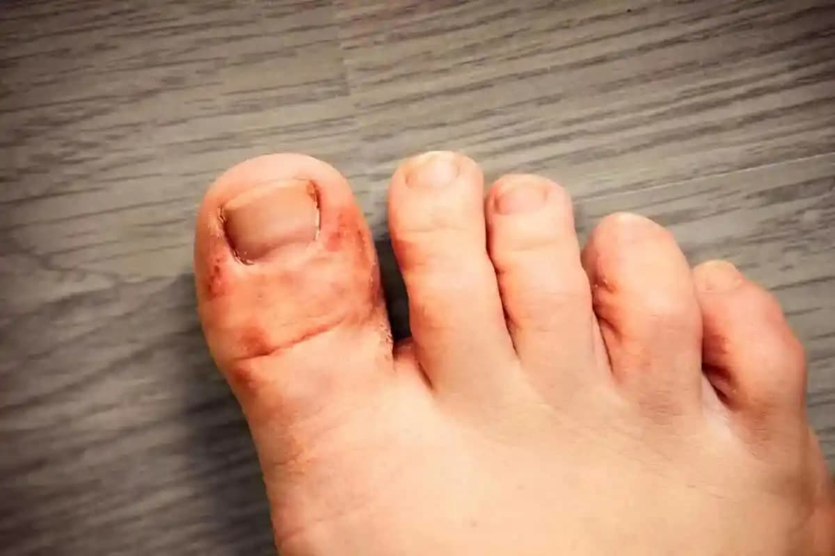 Protez Tırnak Mantarı: Nedenleri, Önleme Yöntemleri ve Etkili Tedavi Seçenekleri