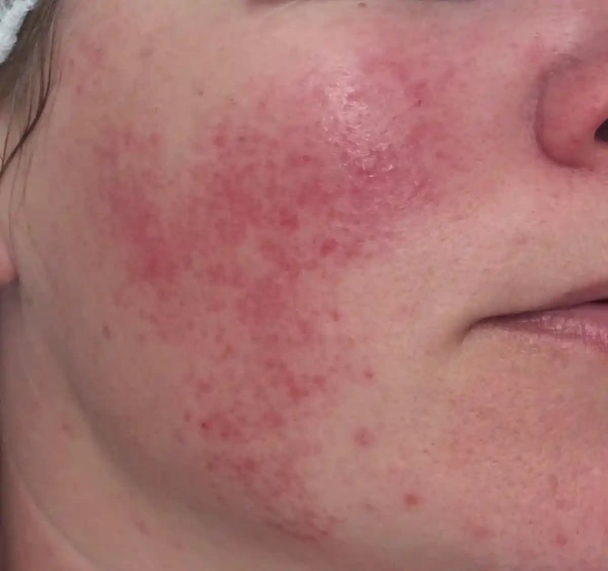 Rozacea: Yüz Kızarıklığı ve Cilt Sağlığı İçin Etkili Bakım ve Tedavi Yöntemleri