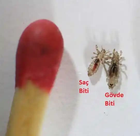 Saç Biti Nedenleri, Belirtileri ve Etkili Tedavi Yöntemleri Hakkında Bilgi