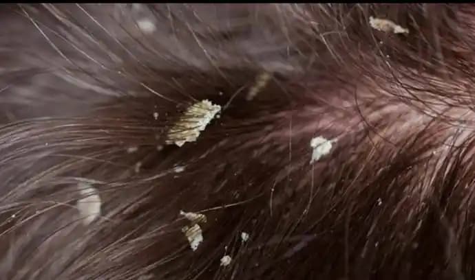 Saç Derisinde Beyaz Tortu Nedenleri ve Etkili Bakım Yöntemleri Hakkında Bilgi