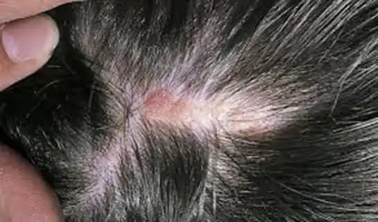 Saç Derisinde Kabuklanma: Nedenleri, Etkili Çözümler ve Bakım Önerileri