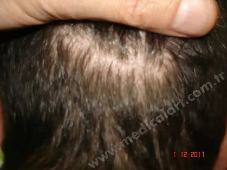 Saç Derisinde Kahverengi Lekeler: Nedenleri, Belirtileri ve Tedavi Yöntemleri